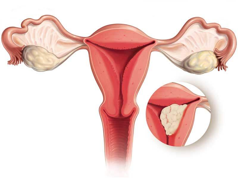 Cancer de Endometrio
