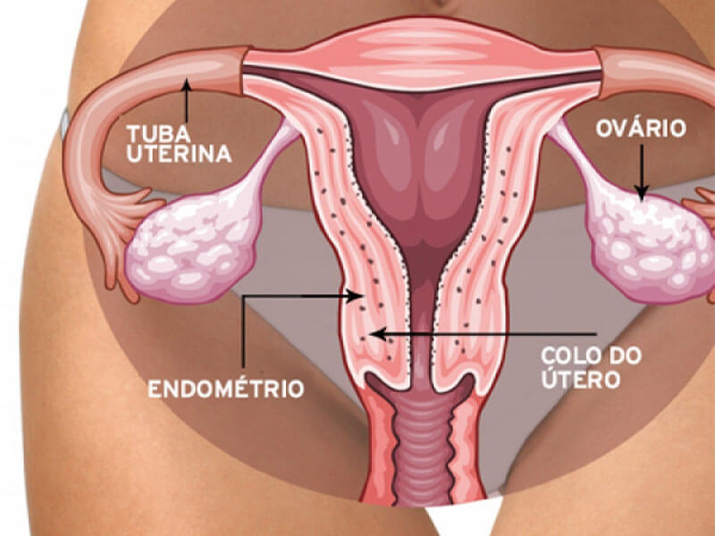 Endometriose