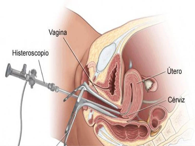 Histeroscopia