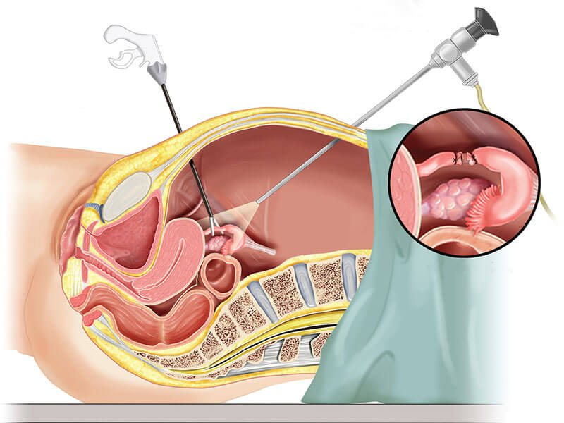 Laparoscopia