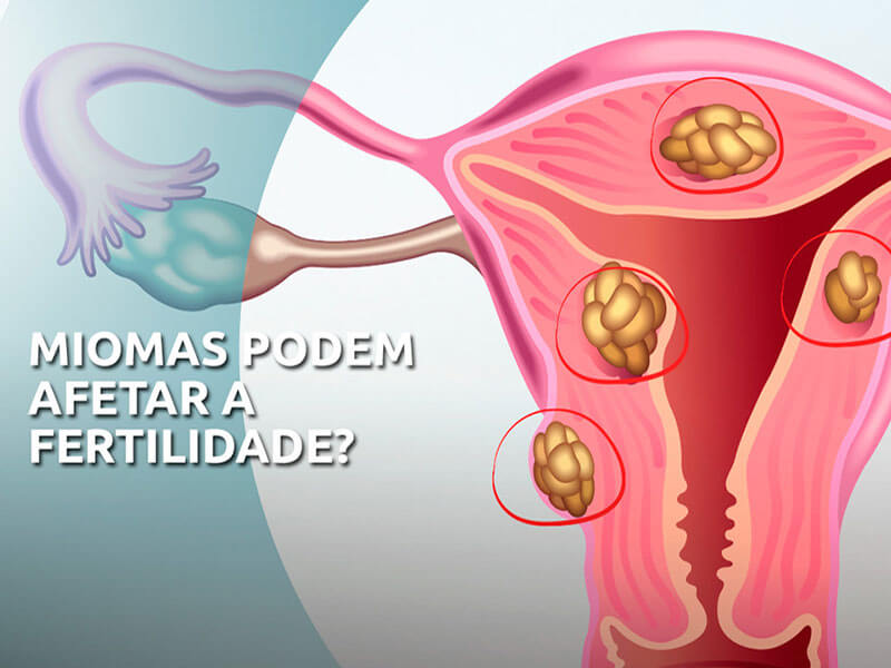Miomatose Uterina