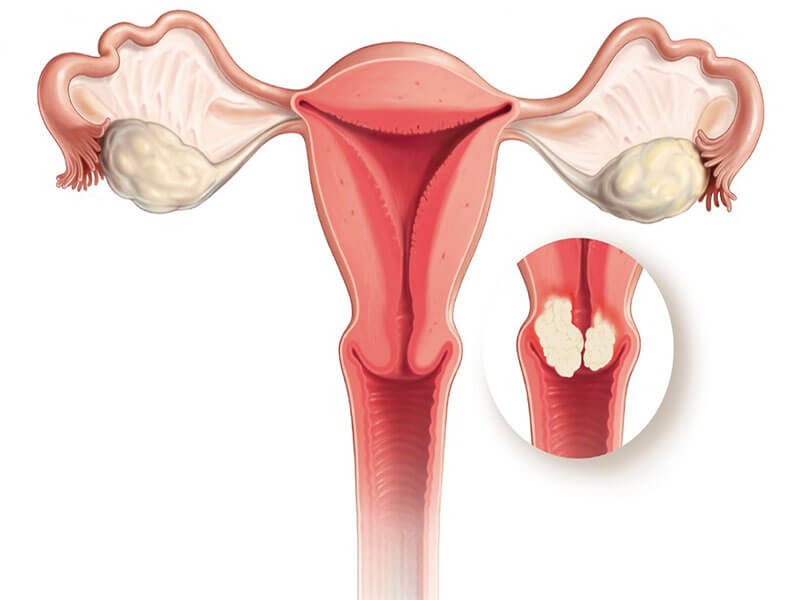 Polipo Uterino